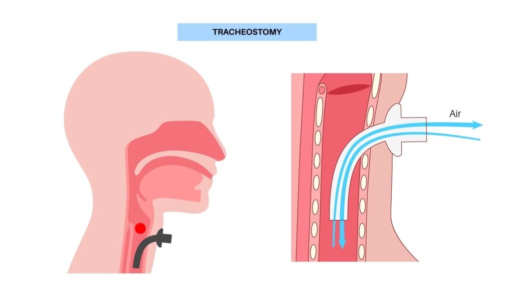 Dilatación Esofágica